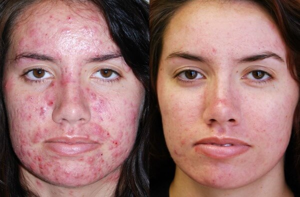 skin infusion therapy