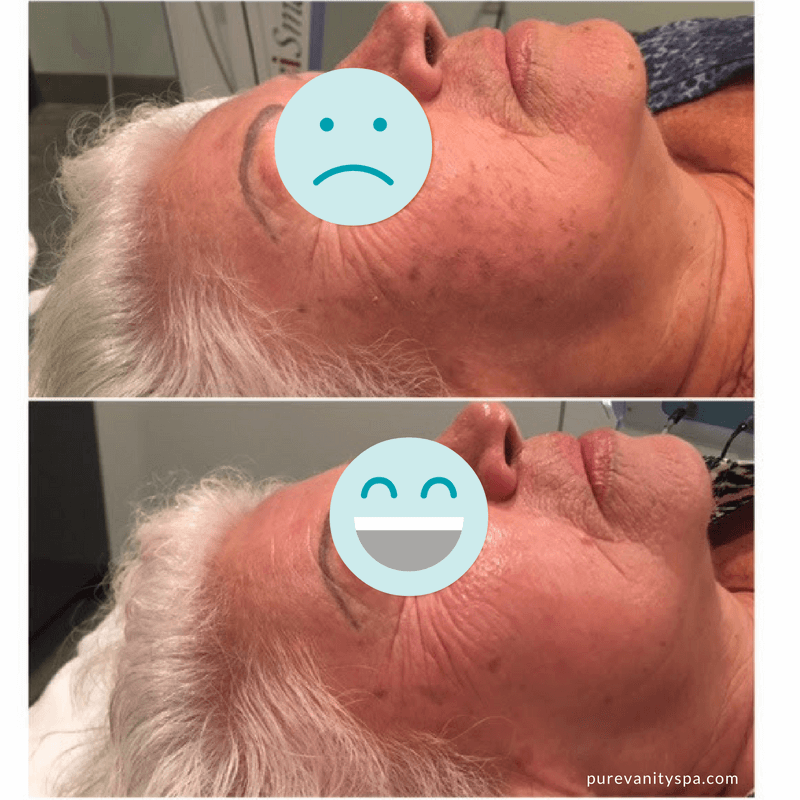 Perfect Peel Before and After